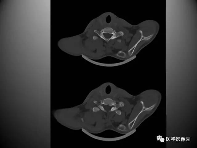 【病例】先天性肩胛骨高位症1例CT影像表现