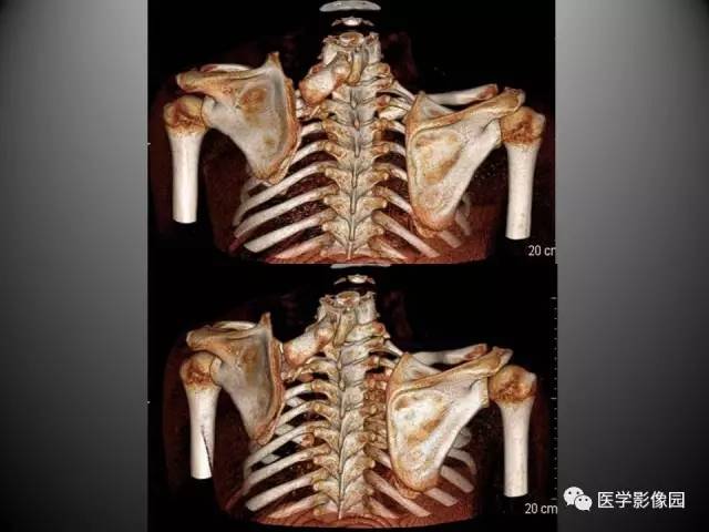 【病例】先天性肩胛骨高位症1例CT影像表现