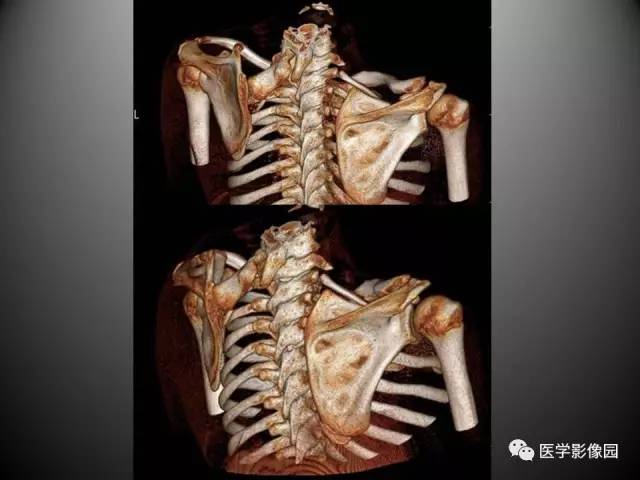 【病例】先天性肩胛骨高位症1例CT影像表现