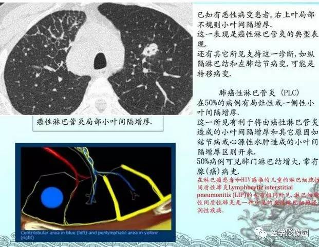 【PPT】肺部HRCT基本影像征象