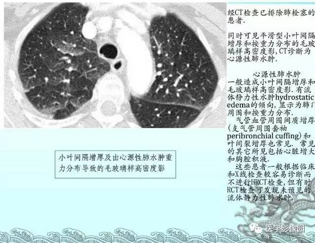 【PPT】肺部HRCT基本影像征象
