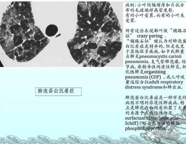 【PPT】肺部HRCT基本影像征象