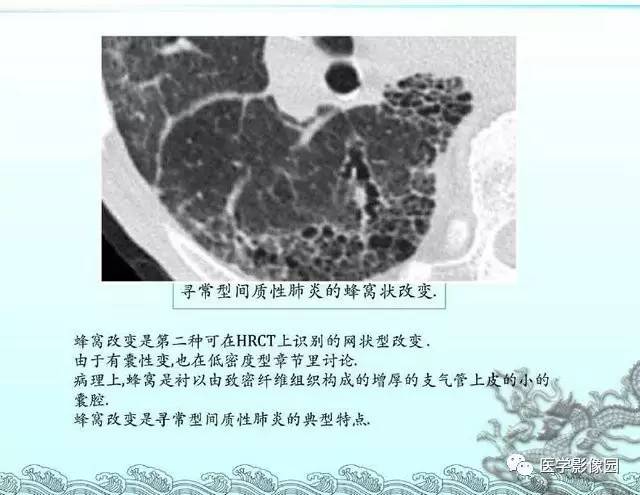 【PPT】肺部HRCT基本影像征象