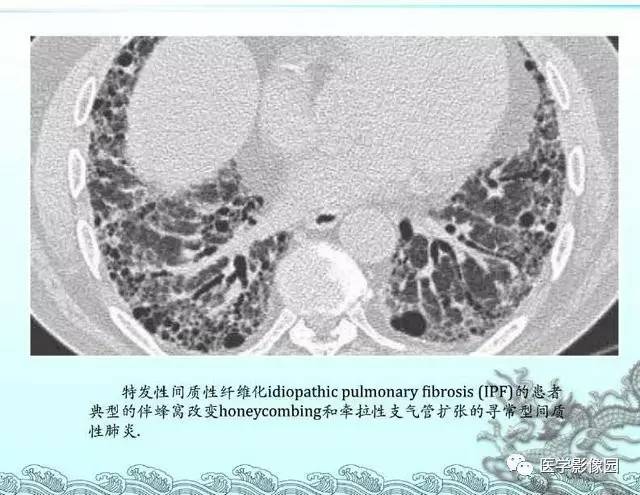 【PPT】肺部HRCT基本影像征象