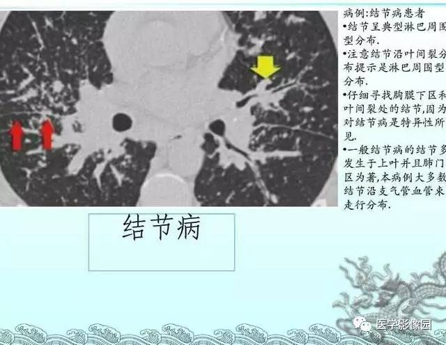【PPT】肺部HRCT基本影像征象