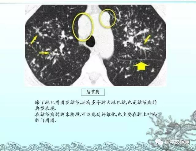 【PPT】肺部HRCT基本影像征象