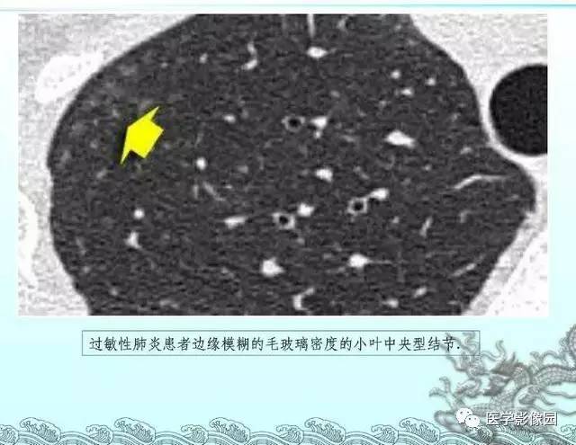 【PPT】肺部HRCT基本影像征象