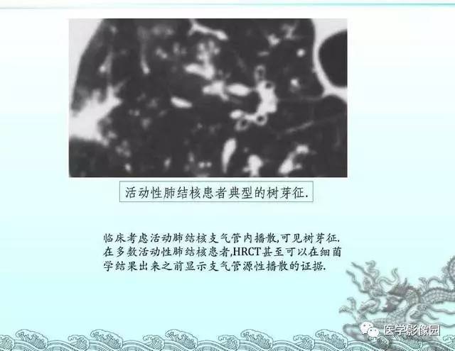 【PPT】肺部HRCT基本影像征象