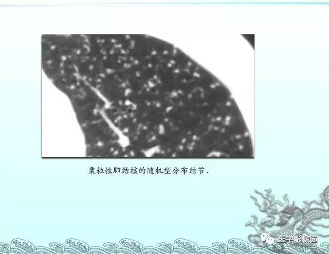【PPT】肺部HRCT基本影像征象