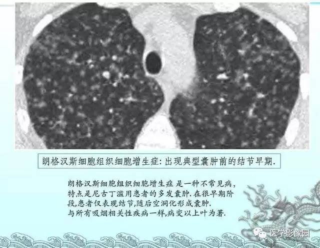 【PPT】肺部HRCT基本影像征象