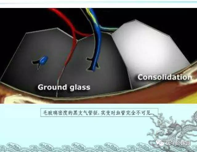 【PPT】肺部HRCT基本影像征象