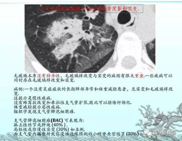 【PPT】肺部HRCT基本影像征象