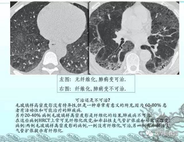 【PPT】肺部HRCT基本影像征象