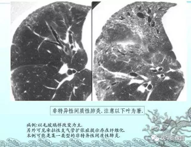 【PPT】肺部HRCT基本影像征象
