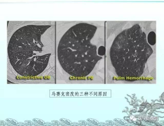 【PPT】肺部HRCT基本影像征象