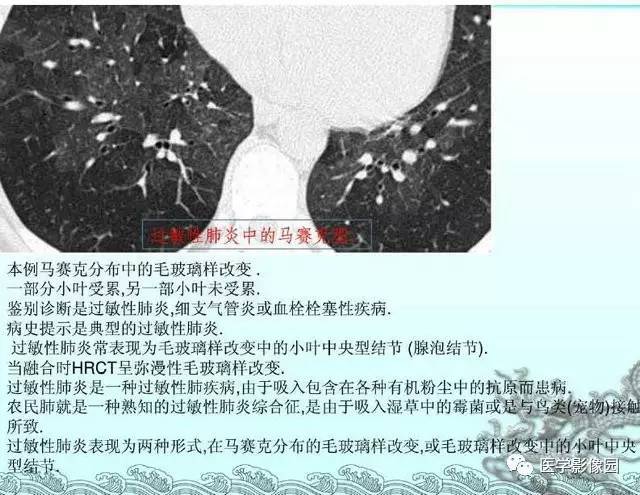 【PPT】肺部HRCT基本影像征象