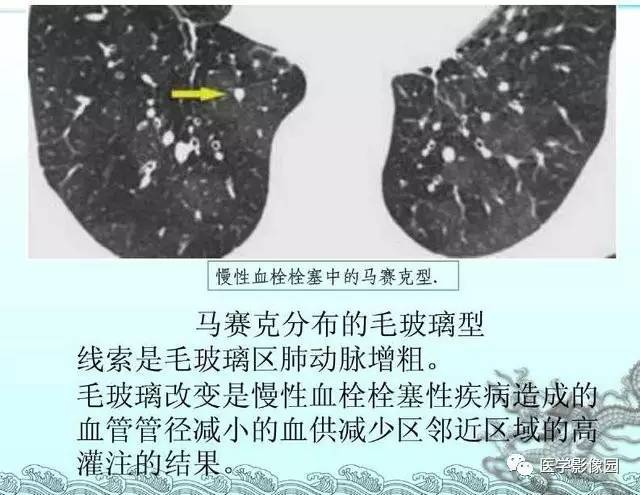 【PPT】肺部HRCT基本影像征象