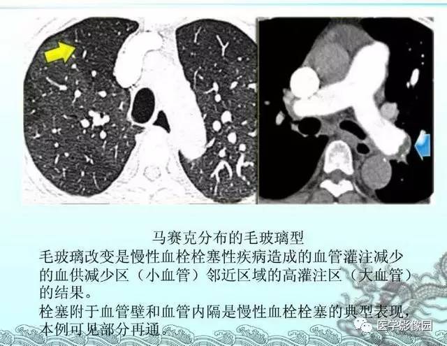【PPT】肺部HRCT基本影像征象