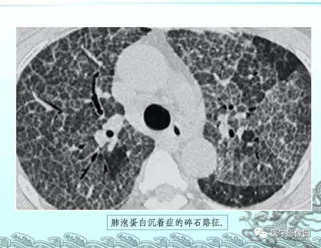 【PPT】肺部HRCT基本影像征象