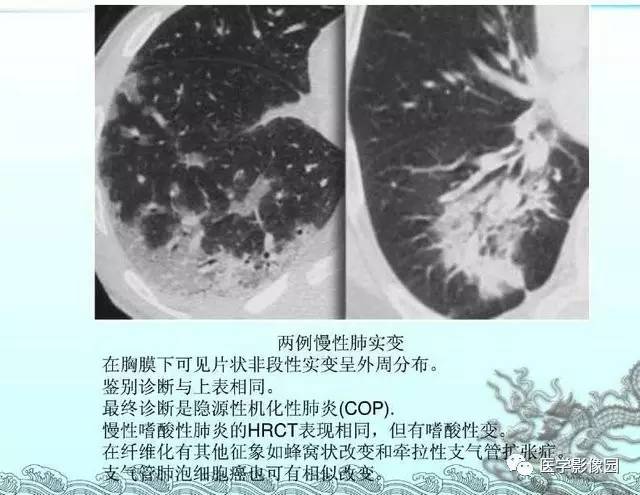 【PPT】肺部HRCT基本影像征象