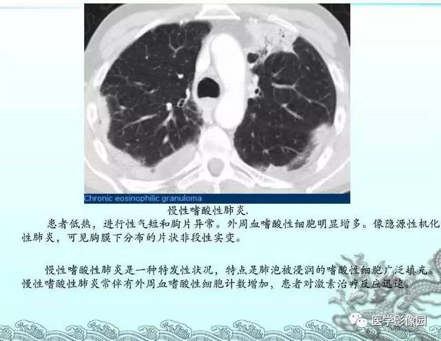 【PPT】肺部HRCT基本影像征象