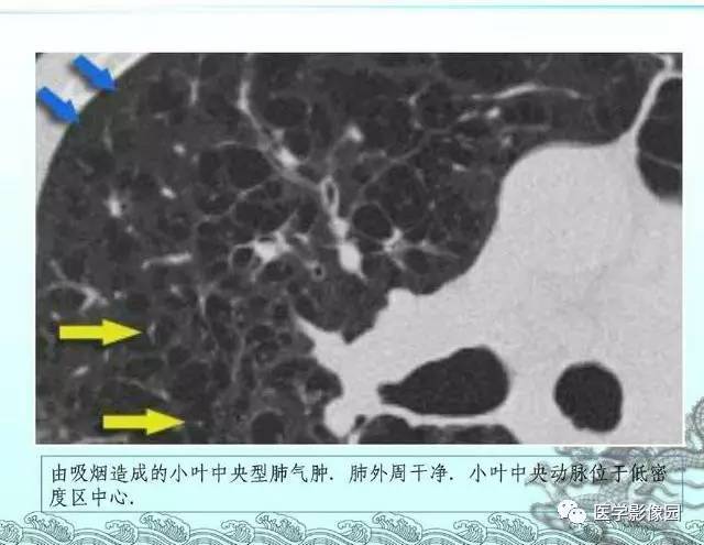 【PPT】肺部HRCT基本影像征象