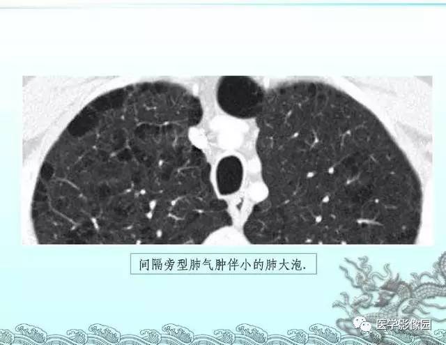 【PPT】肺部HRCT基本影像征象