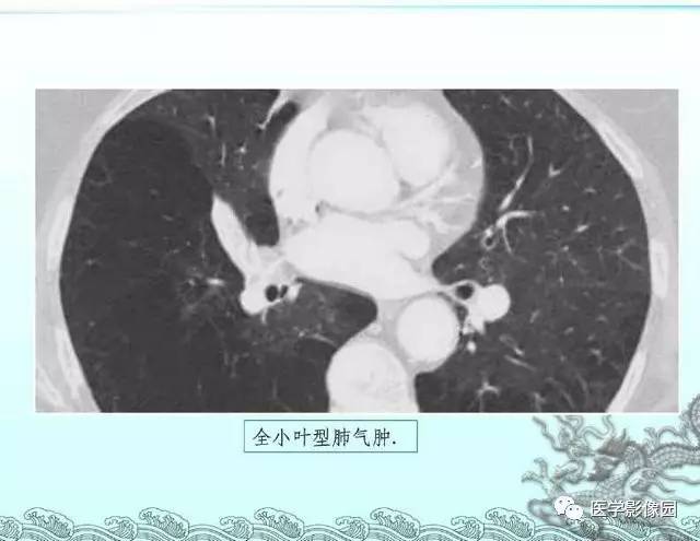 【PPT】肺部HRCT基本影像征象