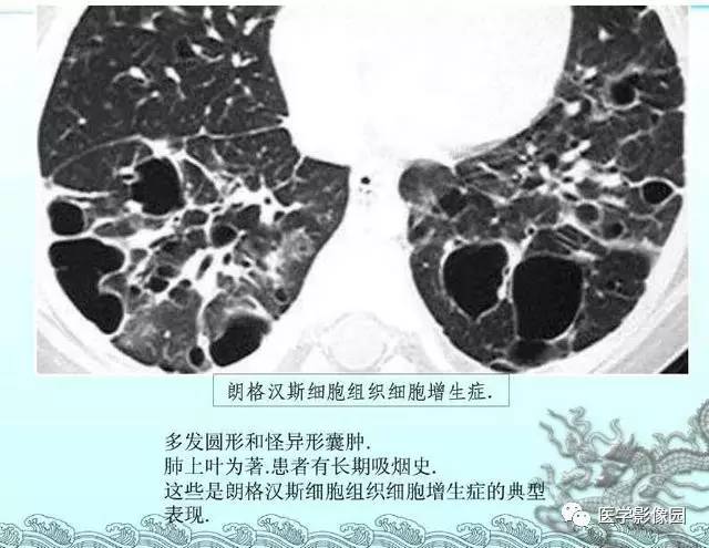 【PPT】肺部HRCT基本影像征象