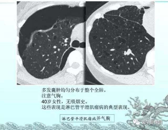 【PPT】肺部HRCT基本影像征象
