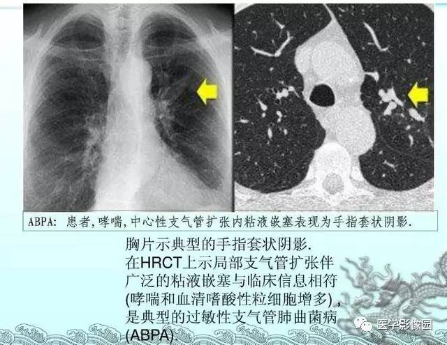 【PPT】肺部HRCT基本影像征象