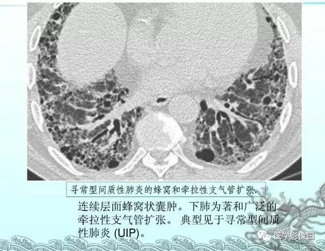 【PPT】肺部HRCT基本影像征象