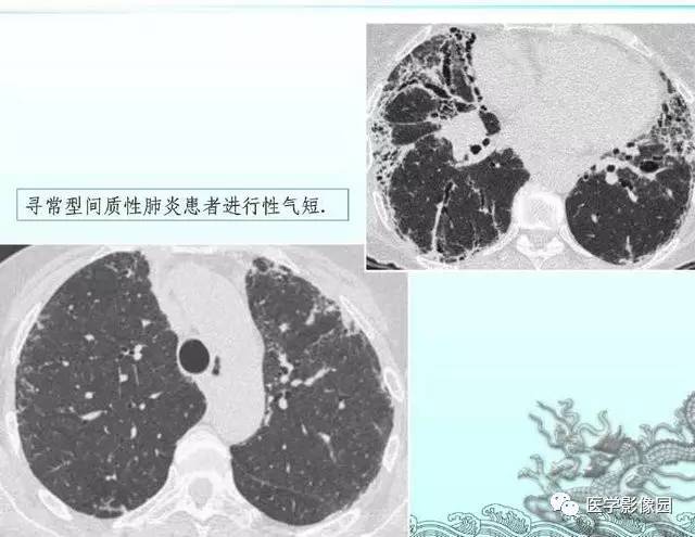 【PPT】肺部HRCT基本影像征象