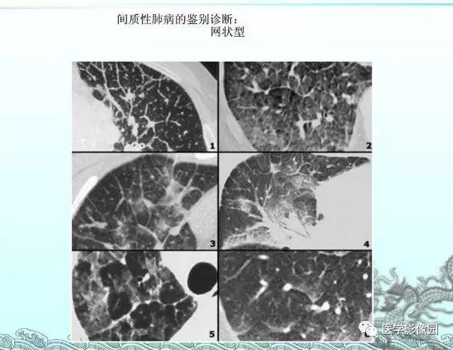 【PPT】肺部HRCT基本影像征象