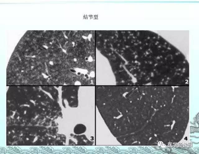 【PPT】肺部HRCT基本影像征象