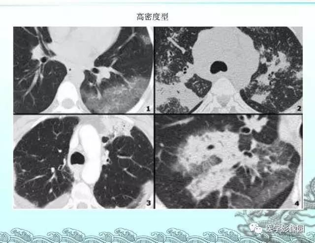 【PPT】肺部HRCT基本影像征象