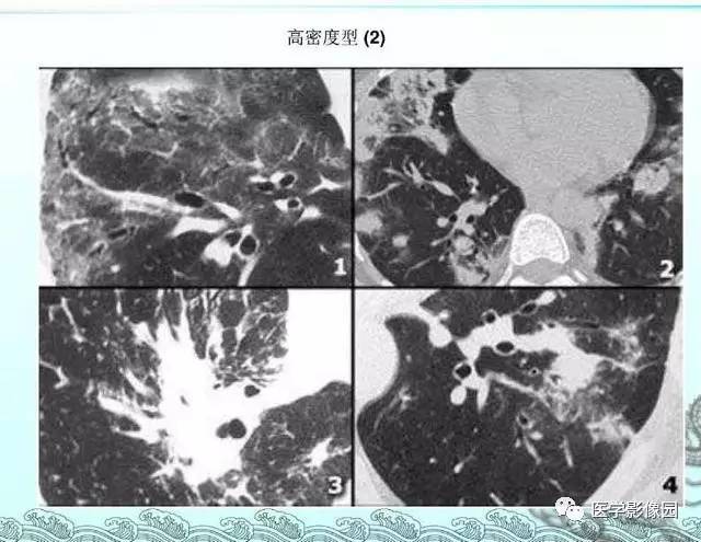 【PPT】肺部HRCT基本影像征象