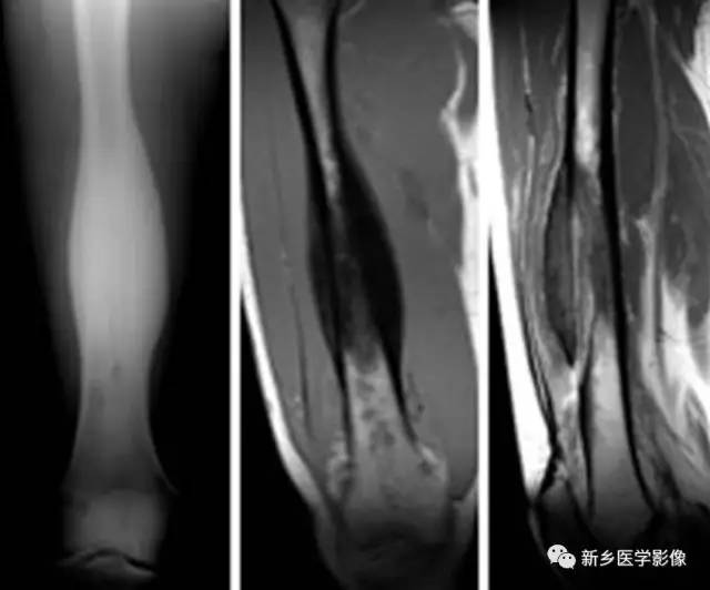 【病例】慢性骨髓炎1例X线MR影像表现