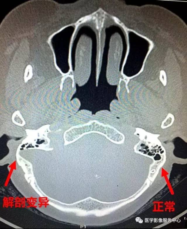 乙状窦前移——1个常见但易被忽略的解剖变异,诊断报告不写可能会导致医疗事故 乙状窦前移——1个常见但易被忽略的解剖变异,诊断报告不写可能会导致医疗事故