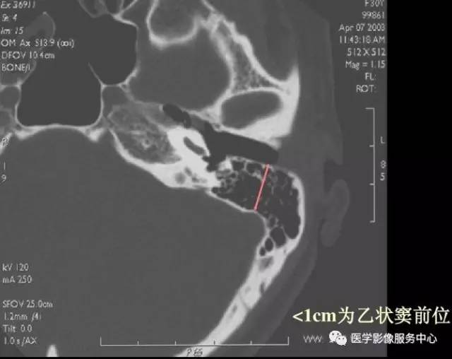 乙状窦前移——1个常见但易被忽略的解剖变异，诊断报告不写可能会导致医疗事故