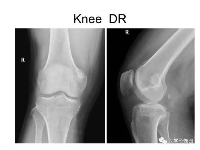 【病例】股骨下段骨母细胞瘤1例X线