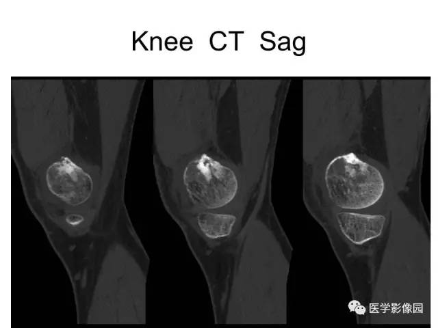 【病例】股骨下段骨母细胞瘤1例X线