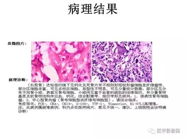 【病例】股骨下段骨母细胞瘤1例X线