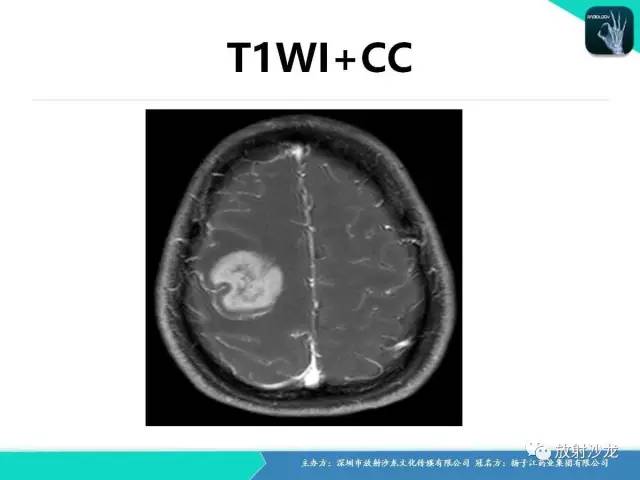 【病例】中枢神经系统淋巴瘤1例影像讨论