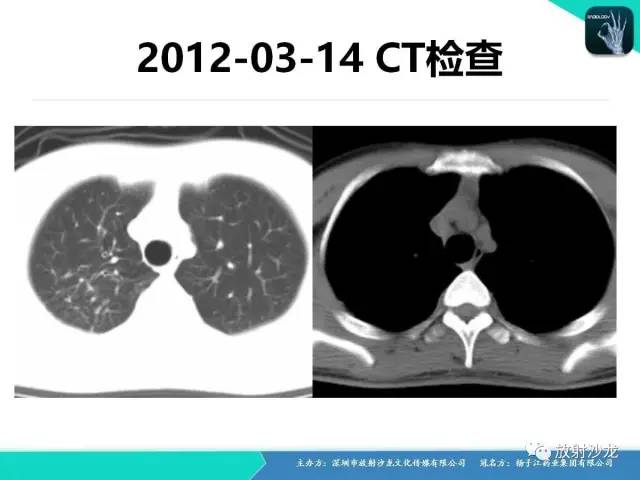 【病例】纵隔生殖细胞肿瘤(内胚窦瘤/卵黄囊瘤)1例CT