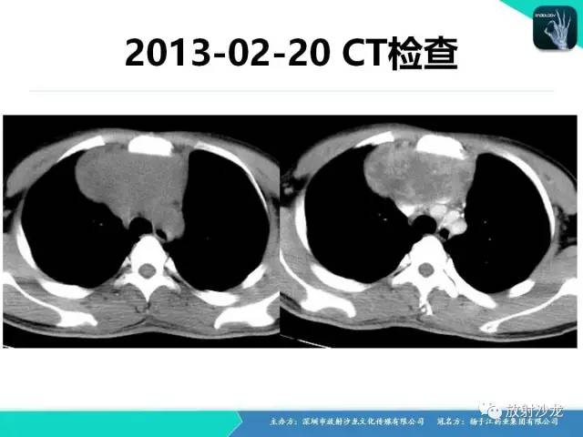 【病例】纵隔生殖细胞肿瘤(内胚窦瘤/卵黄囊瘤)1例CT