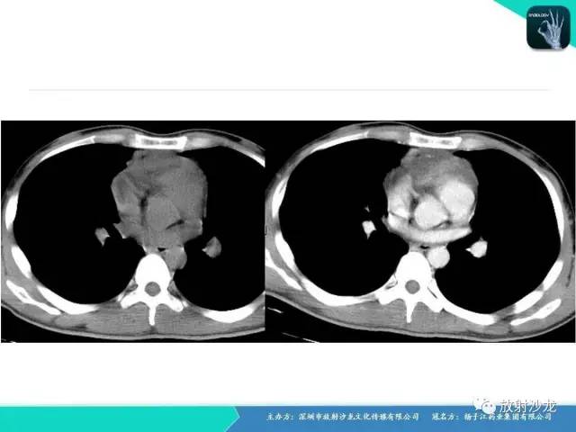 【病例】纵隔生殖细胞肿瘤(内胚窦瘤/卵黄囊瘤)1例CT