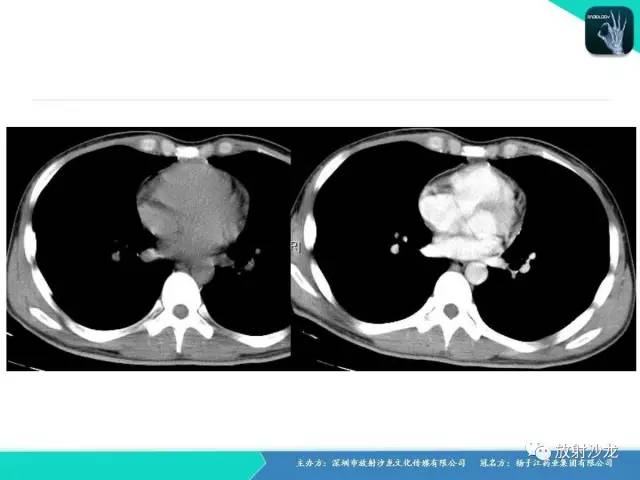 【病例】纵隔生殖细胞肿瘤(内胚窦瘤/卵黄囊瘤)1例CT