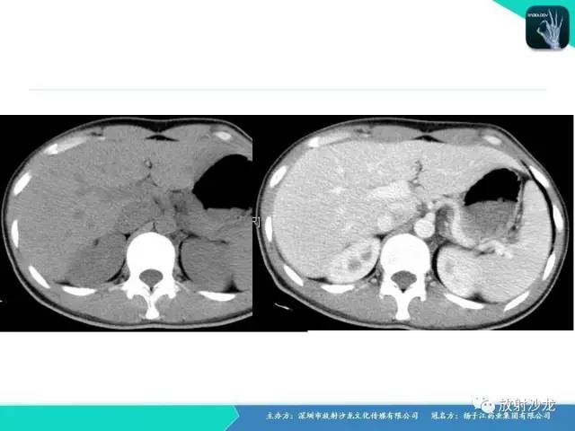 【病例】纵隔生殖细胞肿瘤(内胚窦瘤/卵黄囊瘤)1例CT