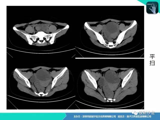 【病例】卵巢硬化性间质瘤1例CT